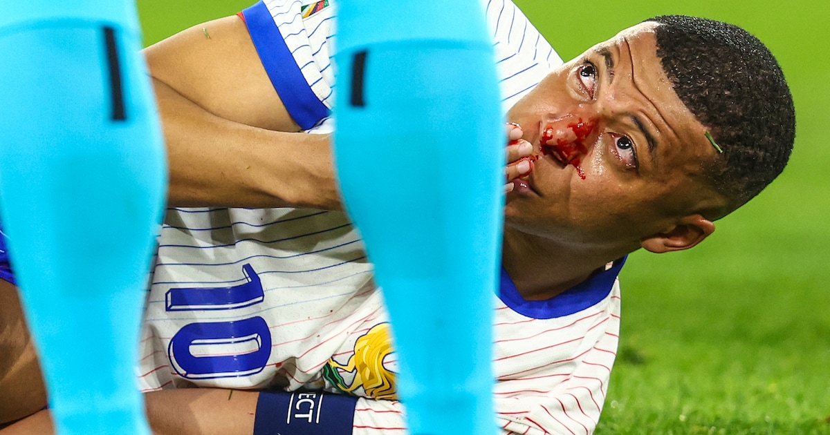 Kan de Franse vedette Kylian Mbappé met een masker voor zijn gebroken