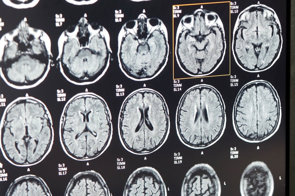 Dyslexie mogelijk veroorzaakt door afwijking hersenen | de Volkskrant