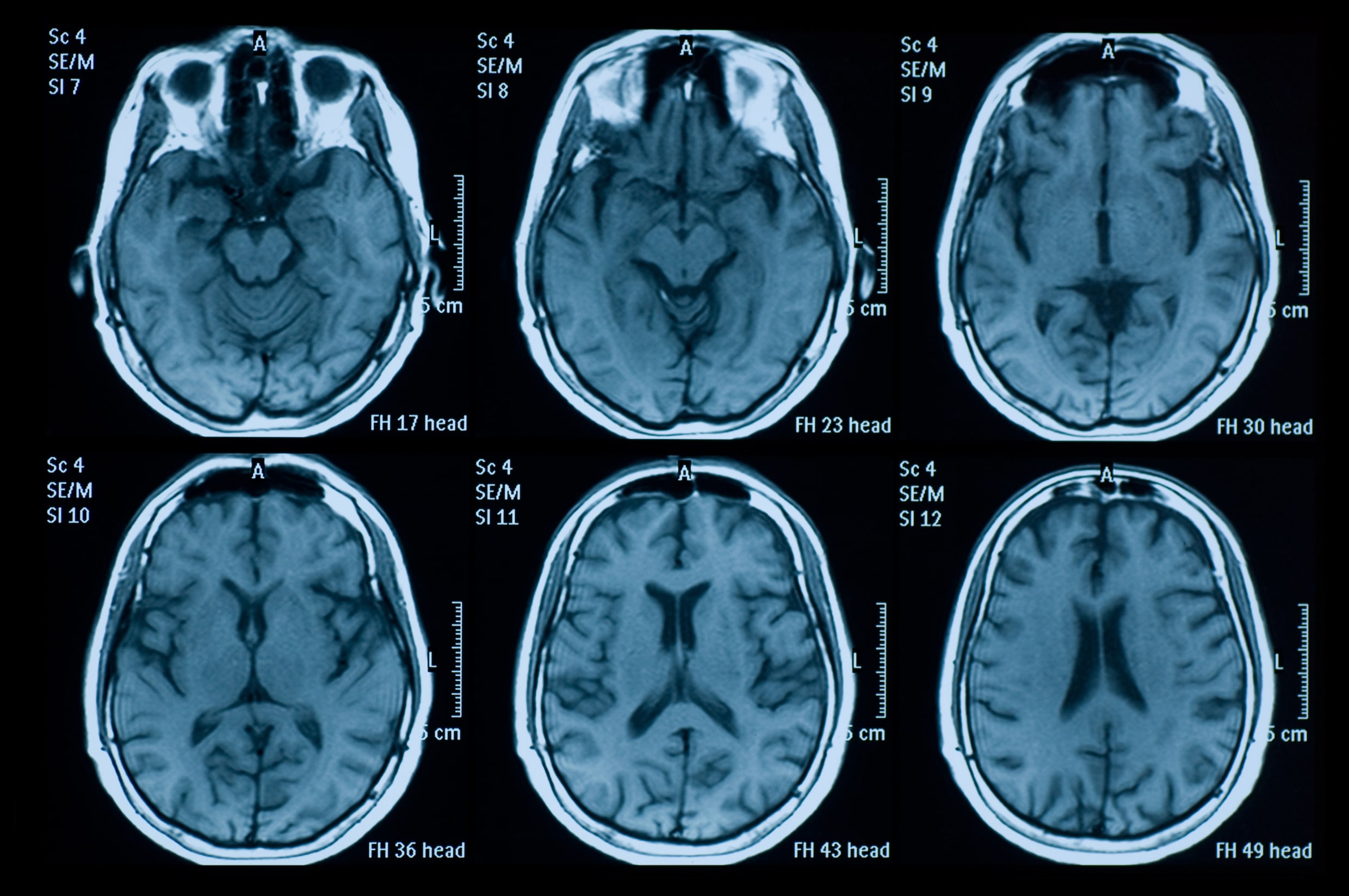 Zonder blindedarm minder parkinson: onderzoek bevestigt vermoeden dat ziekte in de darmen begint