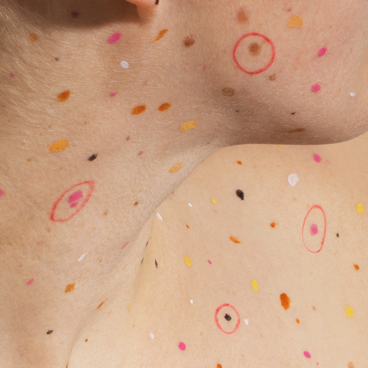 Huidkanker Vlekken Mycosis Fungoides Huidarts.com