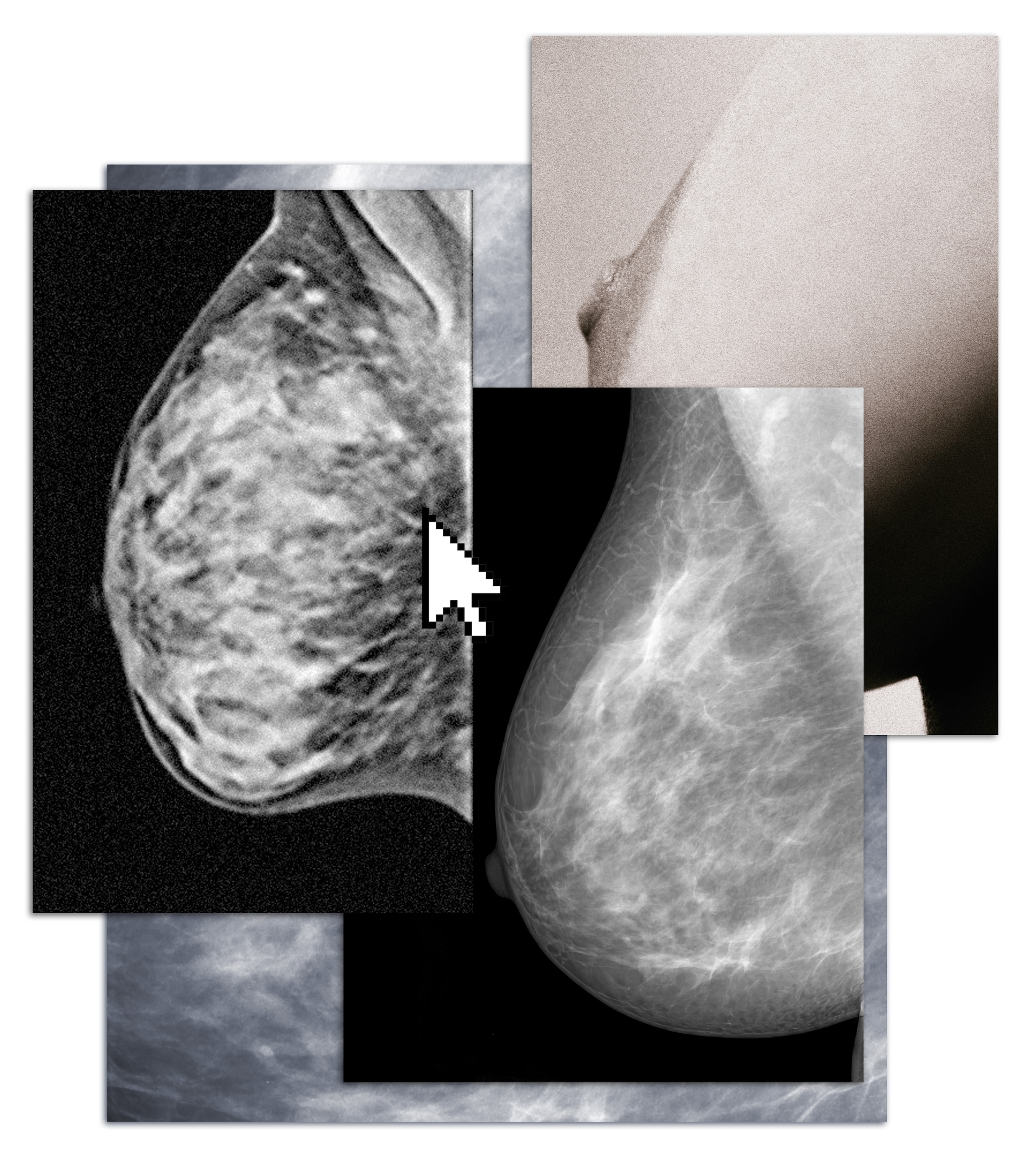 de-mri-om-tumoren-op-te-sporen-bij-hoge-borstdichtheid-is-er-nog-niet