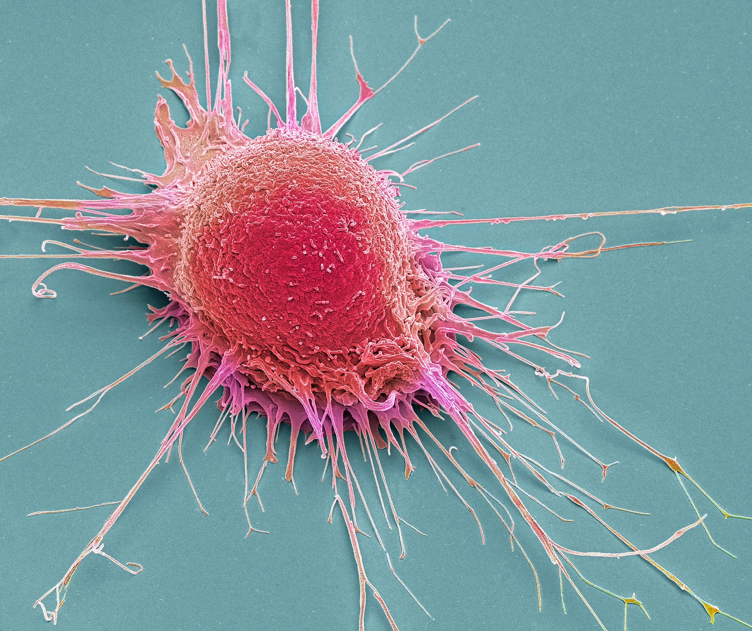 Een kankercel gezien met een elektronenmicroscoop.